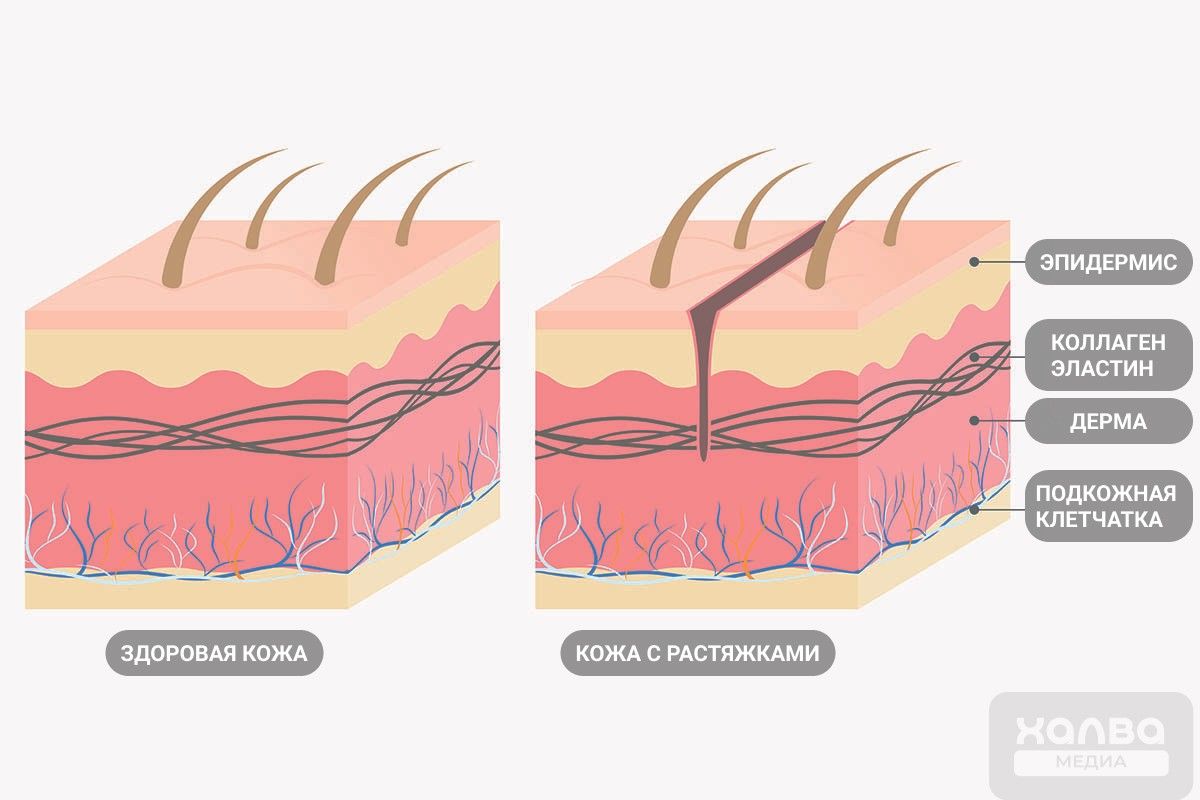 лучший крем от растяжек