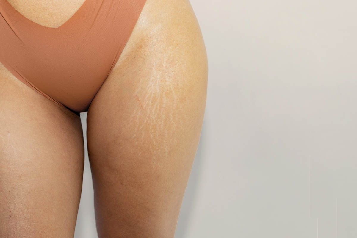 лучший крем от растяжек для беременных