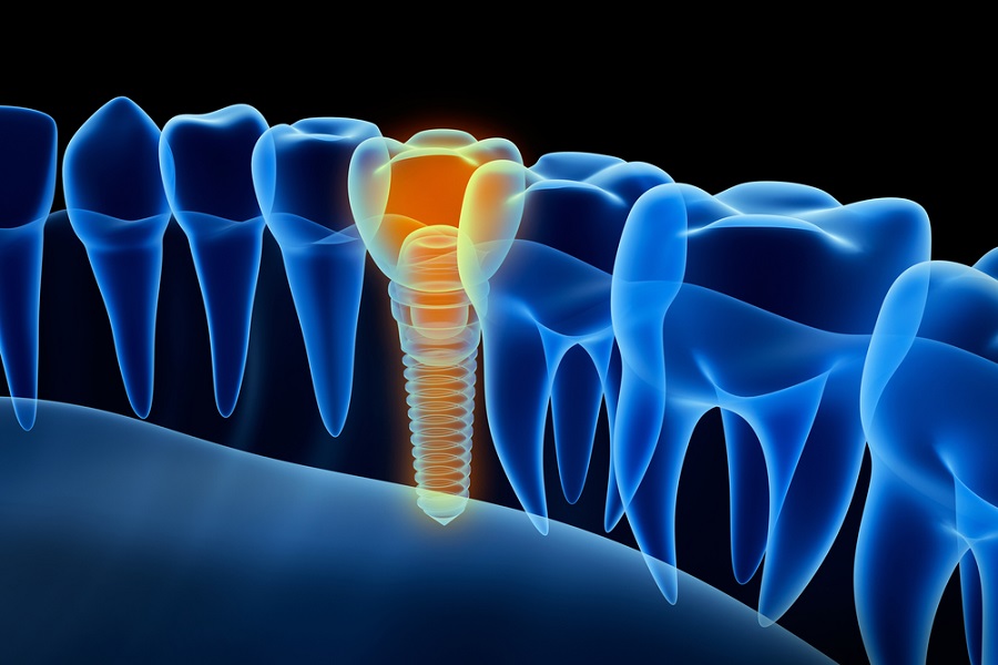 Из чего складывается стоимость зубных имплантов